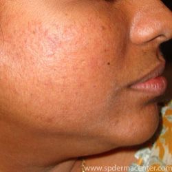 Acne Scar Co2 Fraxel After